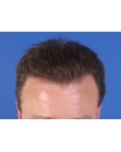 After Hair Transplant&nbsp;Front